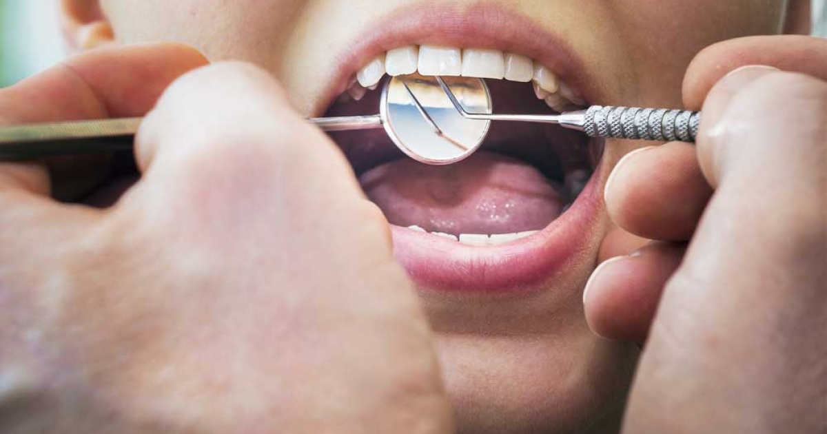 الوقاية من تسوس الأسنان